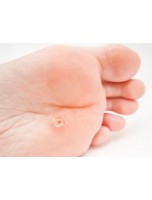 Image de Recette contre les verrues - Les Coffrets de l'Herboriste depuis Packs d'herboriste - Soins naturels pour une santé optimale